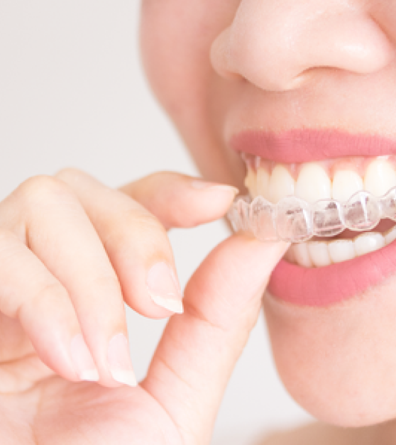 Cost Of Invisalign Tarzana, Encino, Reseda, , Woodland Hills CA